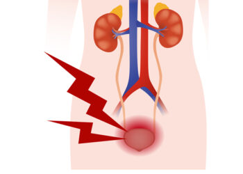 억지로 소변 참으면 신장에 돌 생긴다?