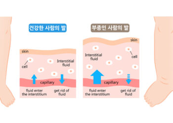 부종의 양방적 진단 및 치료 방법은?