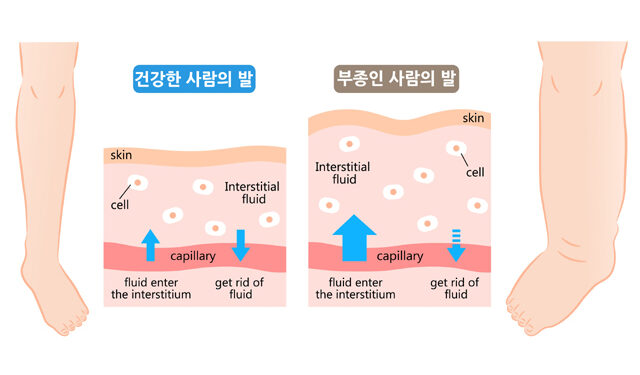 부종의 양방적 진단 및 치료 방법은?