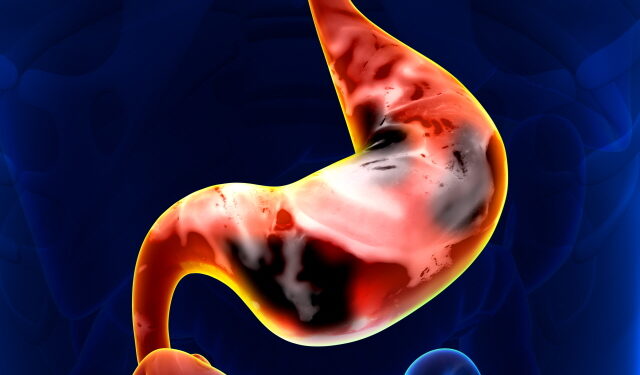 타고·짜고·매운 음식, 위암 발생 위험