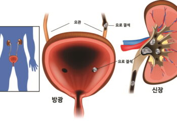 부족한 수분 섭취, 요로에 돌이 쌓인다