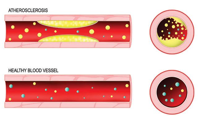 동맥경화는 자가 면역 질환?