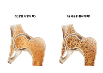 골감소 치료 한약 개발 및 기전 규명