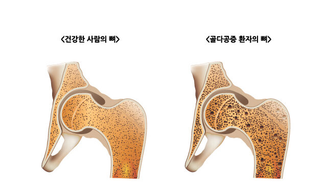 골감소 치료 한약 개발 및 기전 규명
