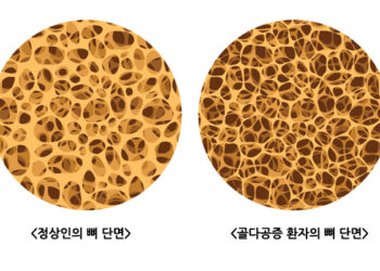 골다공증, 주의할 사람 따로 있다?