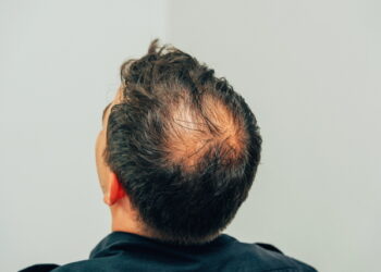 불어나는 남성 정수리탈모 사례, 해결 방안은