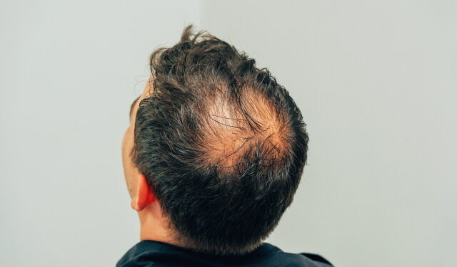 불어나는 남성 정수리탈모 사례, 해결 방안은