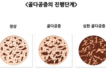 여름철엔 골다공증 골절에 주의