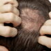 불어나는 남성 정수리탈모, 해결 방안은?