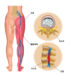 다리 저려 병원 찾았더니 허리디스크?