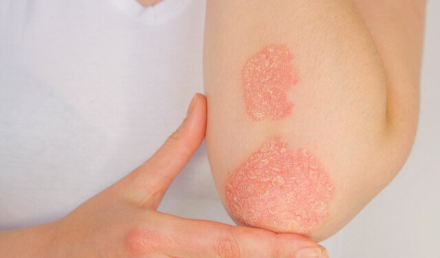 건조한 겨울에 더 고역, ‘성인 아토피 피부염’