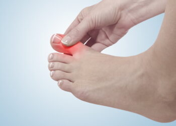 젊은 환자 늘어나는 통풍, 여름철 더 주의