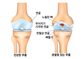 한의표준임상진료지침 (43) 한의학에서 퇴행성관절염은 비증∙역절풍∙각기로 이해