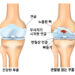 한의표준임상진료지침 (43) 한의학에서 퇴행성관절염은 비증∙역절풍∙각기로 이해