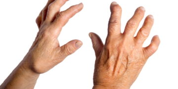 조병식 원장의 최신 동씨침 (21) 심장 관련 질환, 척택∙사화∙방혈을 먼저 고려