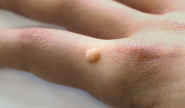 “사마귀, 뜸으로 없앤다!”  효과 확인