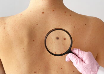 ‘점’인 줄 알았는데 ‘암’…알아두면 좋은 피부암 ‘ABCD룰’