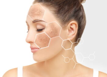 “햇빛이 독?”…여름철 색소침착의 진실