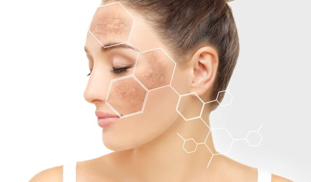 “햇빛이 독?”…여름철 색소침착의 진실