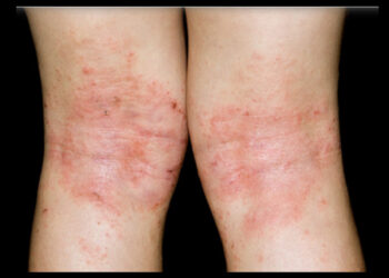 아토피 아동, 라면·햄버거 등 먹으면 가려움 최대 2배로 증가