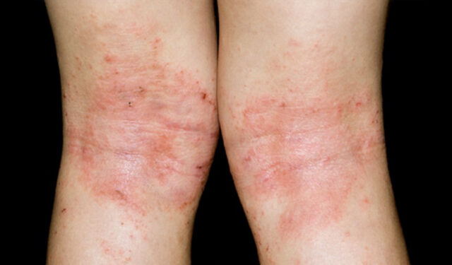 아토피 아동, 라면·햄버거 등 먹으면 가려움 최대 2배로 증가