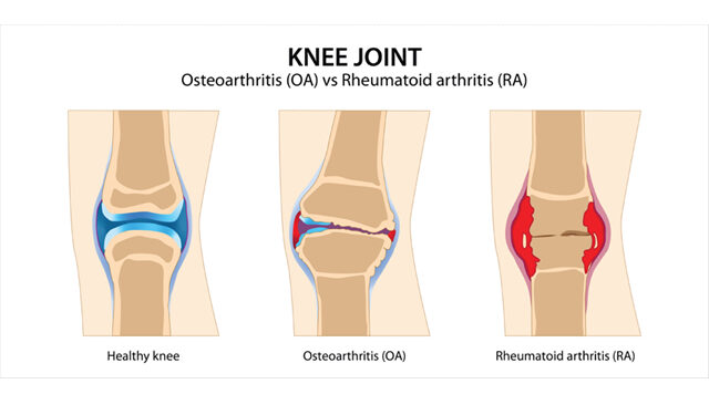 한의표준임상진료지침 (57) 류마티스 관절염, 자가면역으로 인한 만성 염증성 질환