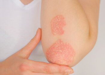 봄철 급증 ‘피부 알레르기’ 주의