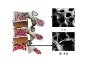 50대 여성 4분의 1 골다공증…”엉덩이뼈 골절시 최대 30% 사망”