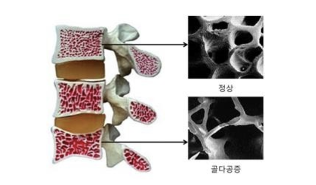 50대 여성 4분의 1 골다공증…”엉덩이뼈 골절시 최대 30% 사망”