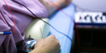 전침(電鍼)의 “불면증 개선 효과” 과학적 규명