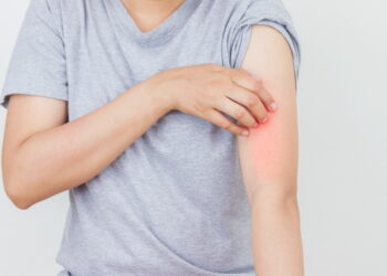 봄철 건선주의보, 보습만으로는 부족