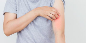 봄철 건선주의보, 보습만으로는 부족