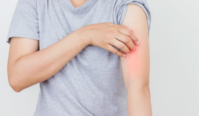 봄철 건선주의보, 보습만으로는 부족