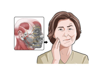 봄철 안면마비, 초기 72시간내 치료중요! 한의 치료도 OK!