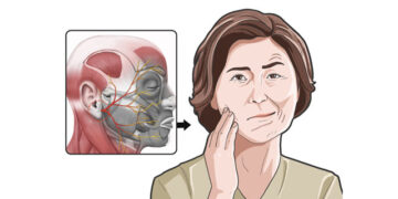 봄철 안면마비, 초기 72시간내 치료중요! 한의 치료도 OK!