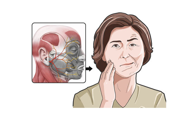 봄철 안면마비, 초기 72시간내 치료중요! 한의 치료도 OK!