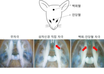 침치료, 외상후스트레스장애(PTSD)의 “우울·불안” 동시 완화!