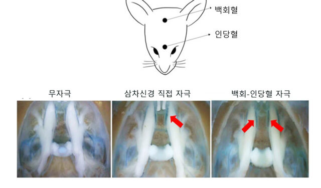 침치료, 외상후스트레스장애(PTSD)의 “우울·불안” 동시 완화!