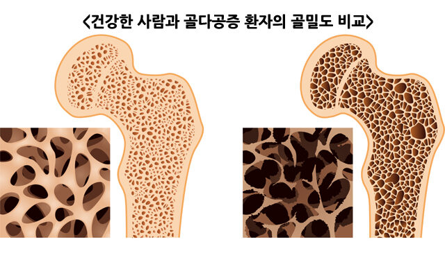 이선탕, 폐경 후 골다공증 골밀도·통증 개선 효과