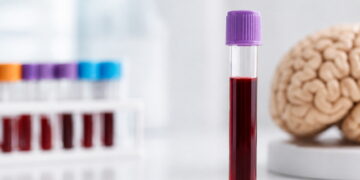 동네병원서 피 한방울로 알츠하이머 진단한다…FDA, 검사법 승인
