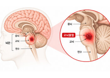 중증 교뇌출혈 환자에 한약·침 병행⋯항생제 사용일수 66일→16일